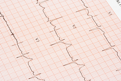 Heart Disease Could Cost U.S. $1 Trillion Per Year by 2035: Report Heart Disease Could Cost U.S. $1 Trillion Per Year by 2035: Report