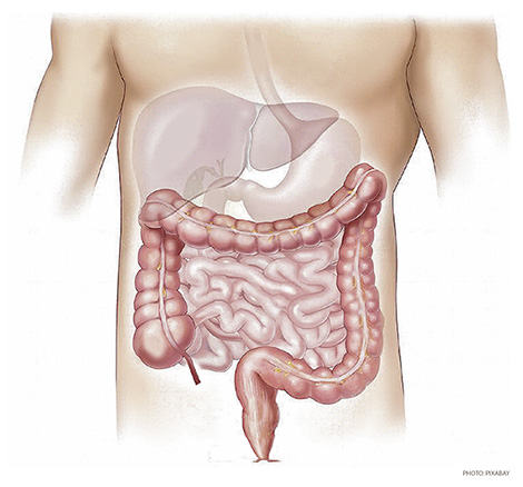 As More Young Americans Diagnosed with Colon Cancer, New Guidelines Lower Screening Age to 45 As More Young Americans Diagnosed with Colon Cancer, New Guidelines Lower Screening Age to 45