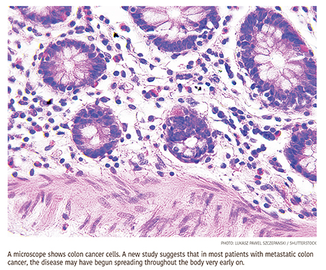 Many Advanced Metastatic Colon Cancers Were ‘Born’ Ready to Spread Many Advanced Metastatic Colon Cancers Were ‘Born’ Ready to Spread
